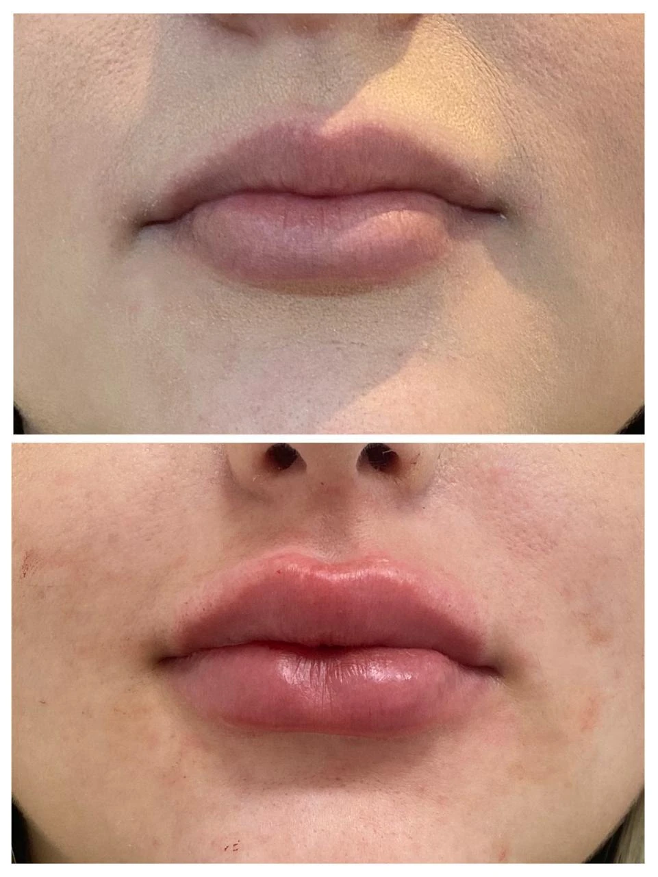 Resultado de harmonia labial — Dra. Tulipa Braga