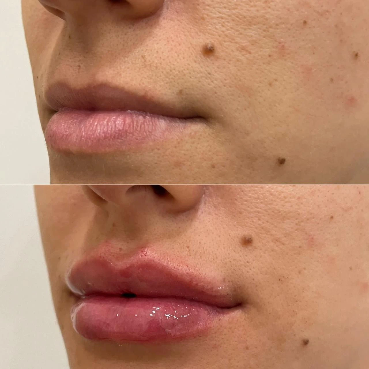 Resultado de contorno e projeção labial — Dra. Tulipa Braga